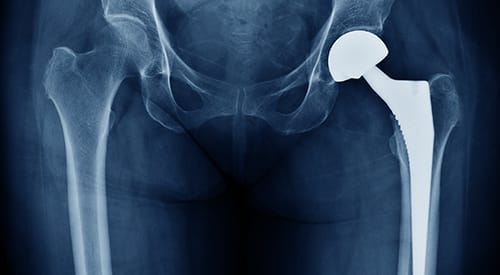 Signature Medical Group Orthopedic Joint Replacement