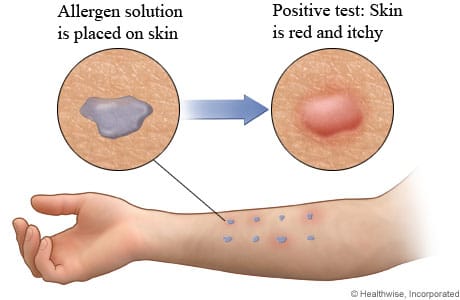 allergy-skin-test