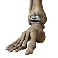 Ankle-implant