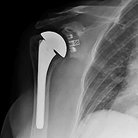 shoulder_implant