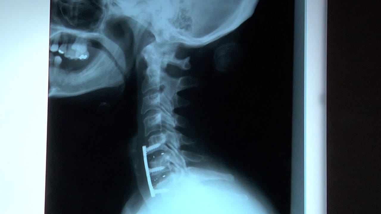 Spinal fusion x-ray