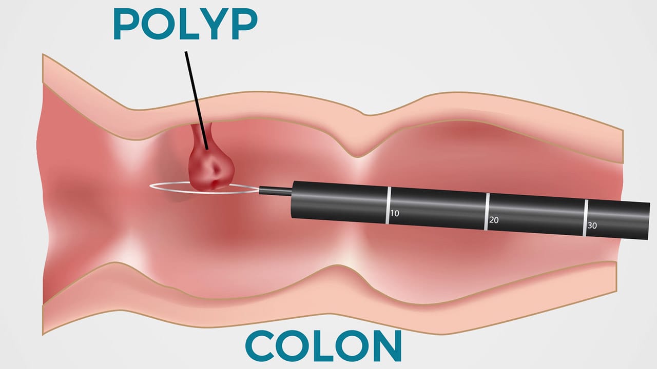 Colon cancer removal diagram
