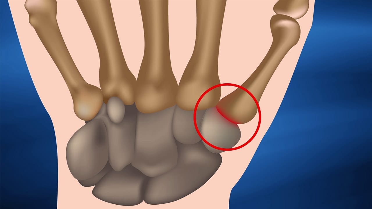 Basilar thumb joint