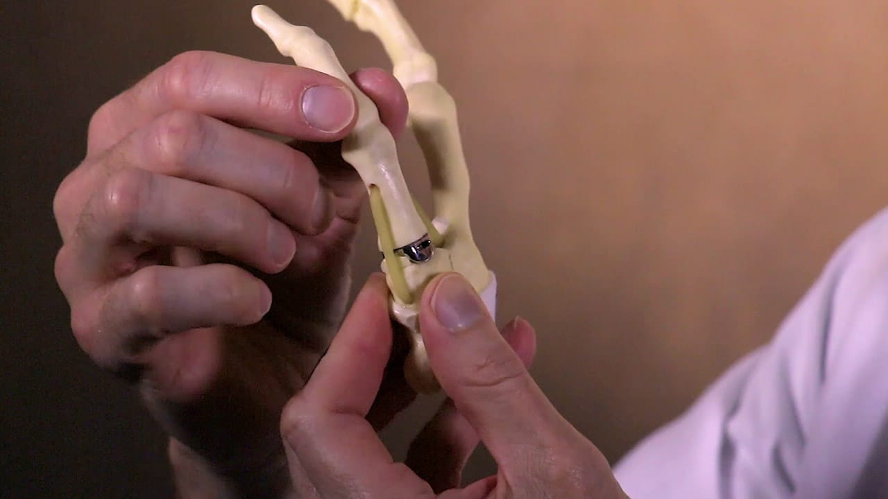 Thumb model with implant