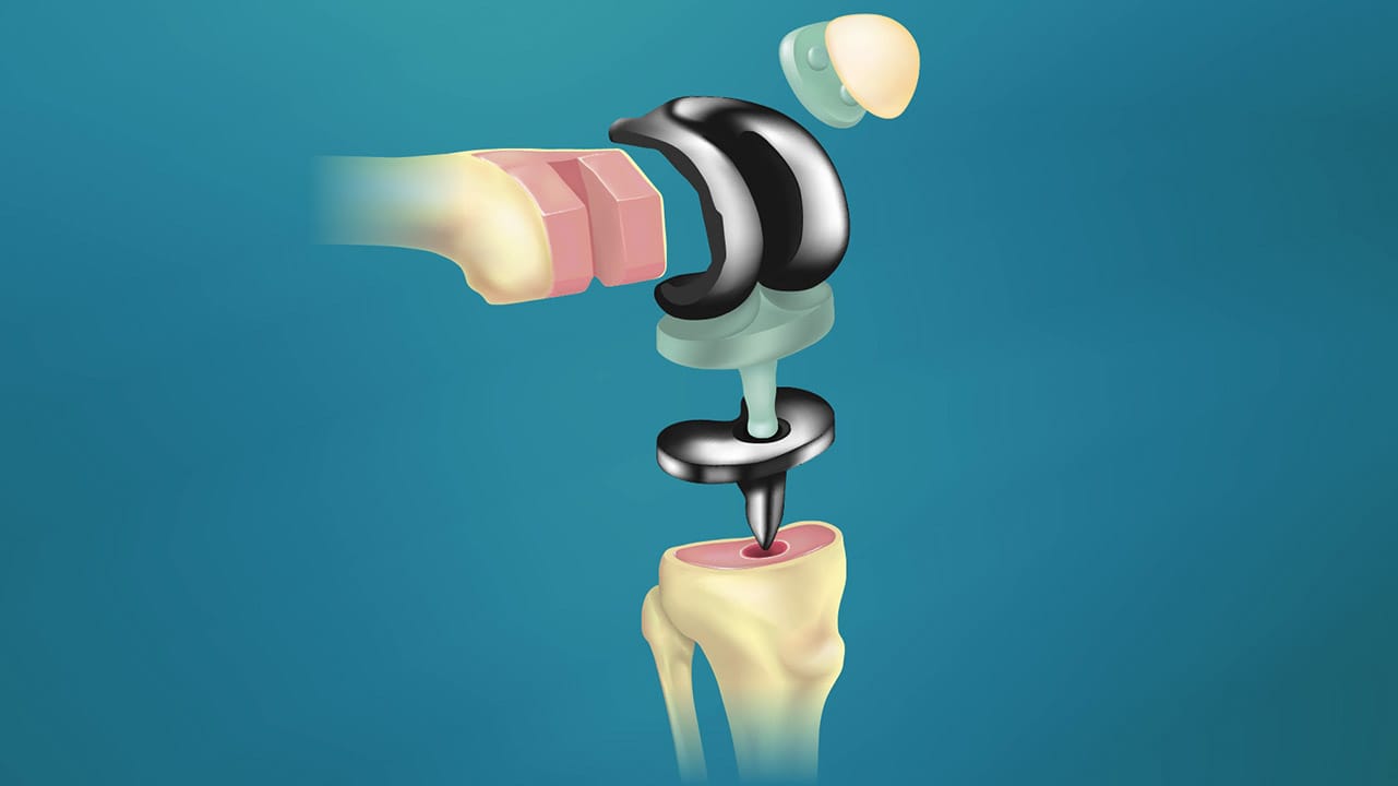 Cementless Knee Replacements - Signature Medical Group