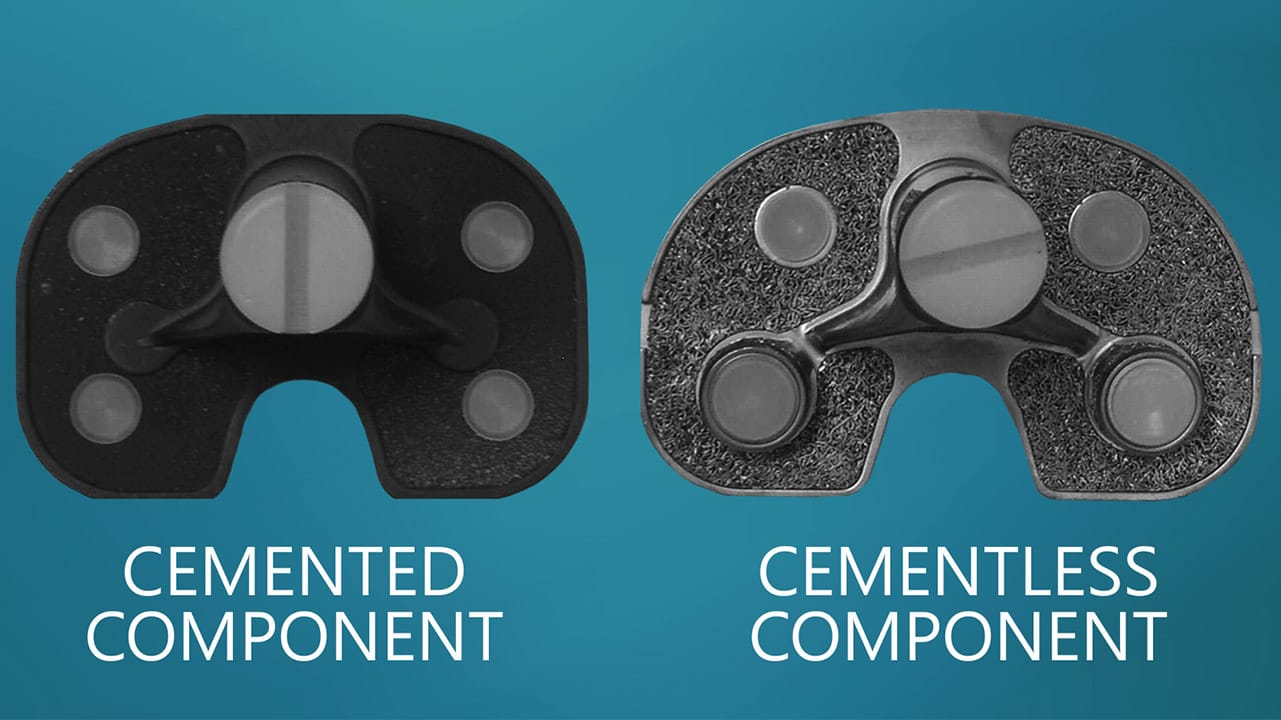 Cemented vs. Cementless replacement components